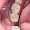 Silver Filling Replacement After